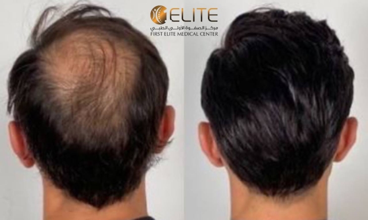  كيف يغير الإكسوزوم مفهوم علاج الصلع الوراثي؟